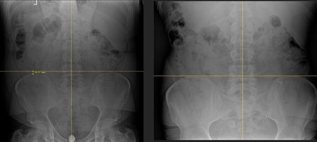 Sciatica 1 Medium.jpeg